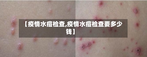 【疫情水痘检查,疫情水痘检查要多少钱】-第2张图片