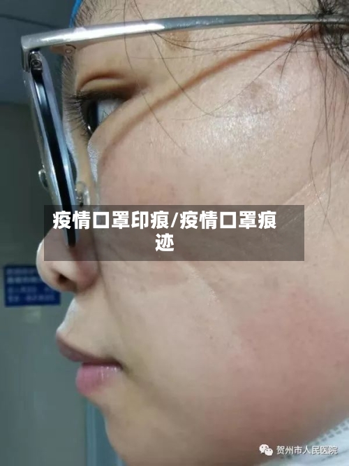 疫情口罩印痕/疫情口罩痕迹-第2张图片