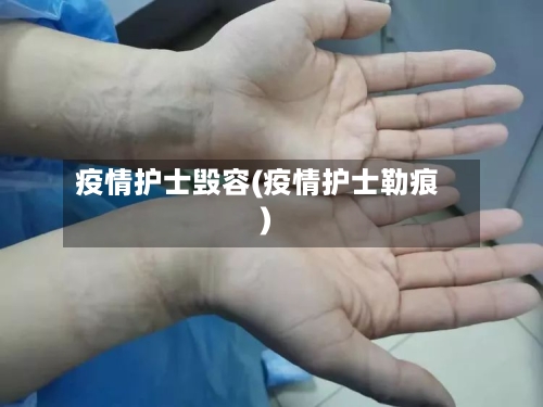疫情护士毁容(疫情护士勒痕)